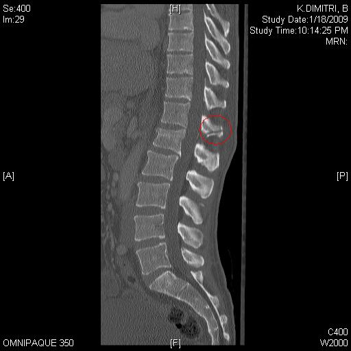 Jan 2009 vertebral column fracture